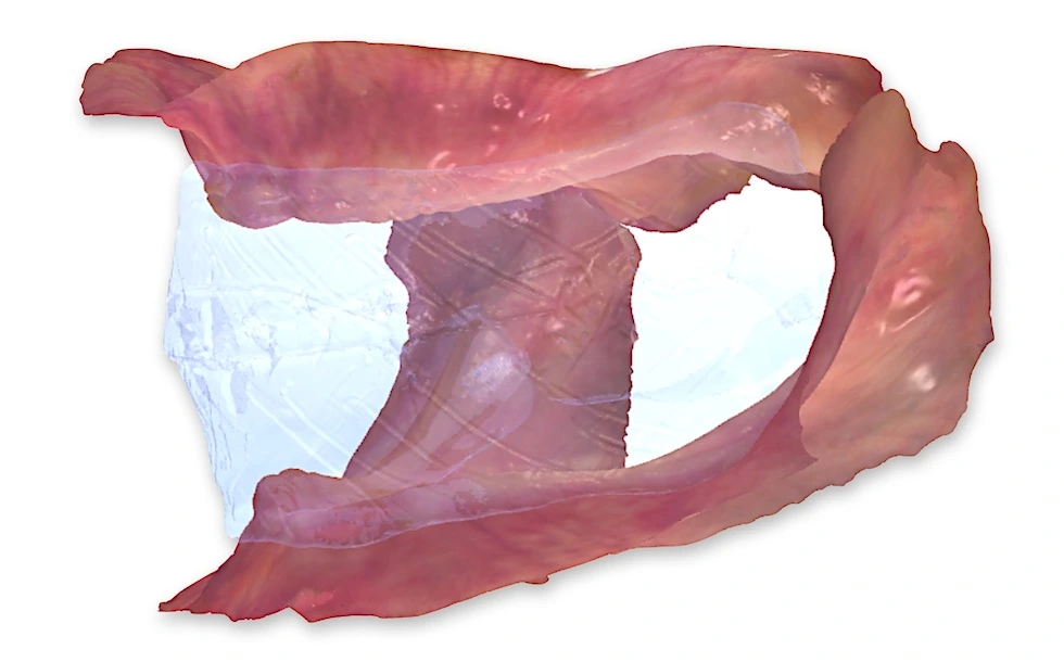 Workflow digitale per protesi totale su scansione intraorale