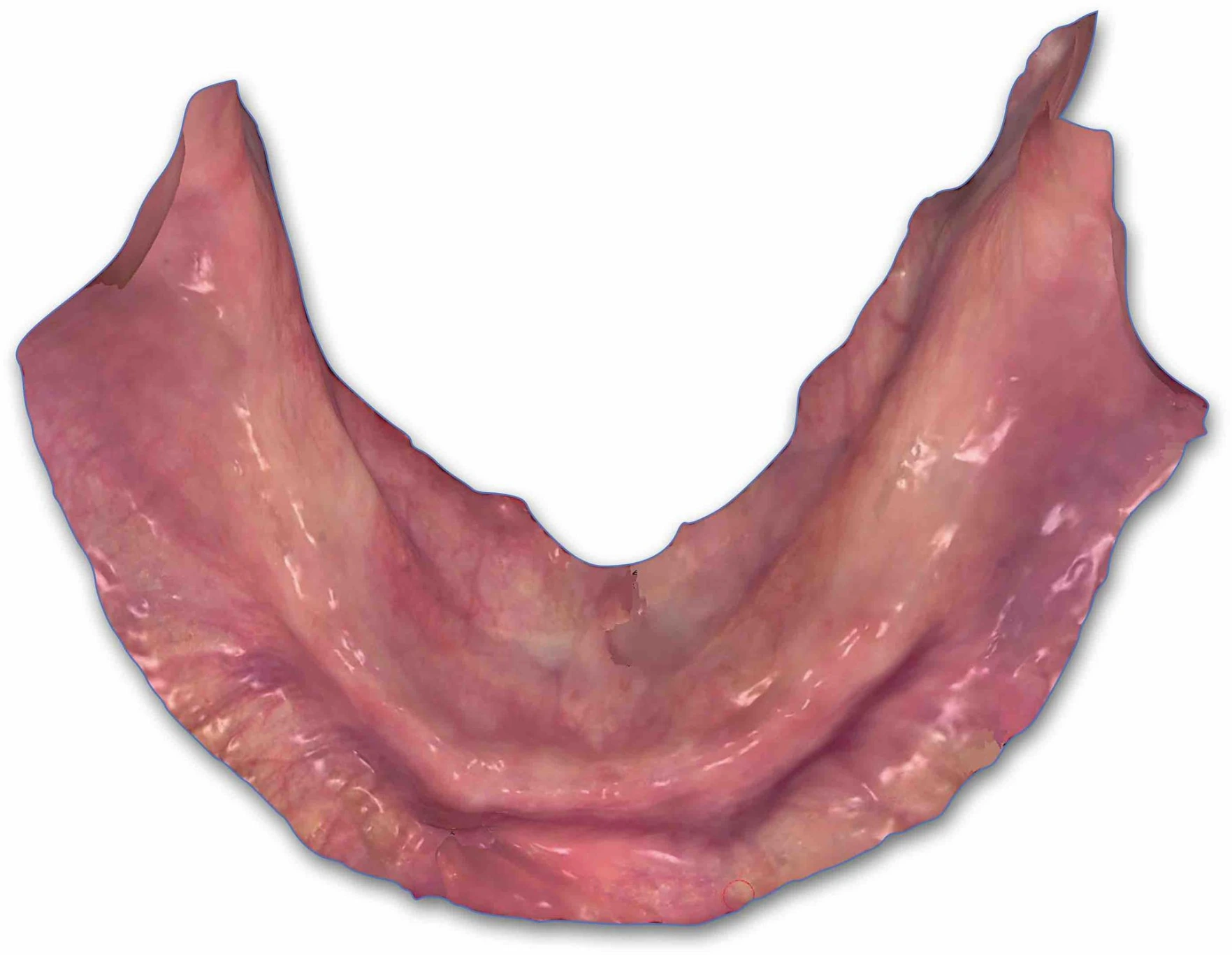 Clinical intraoral scan of the edentulous mandible with tissue retraction and access to the retromylohyoid region
