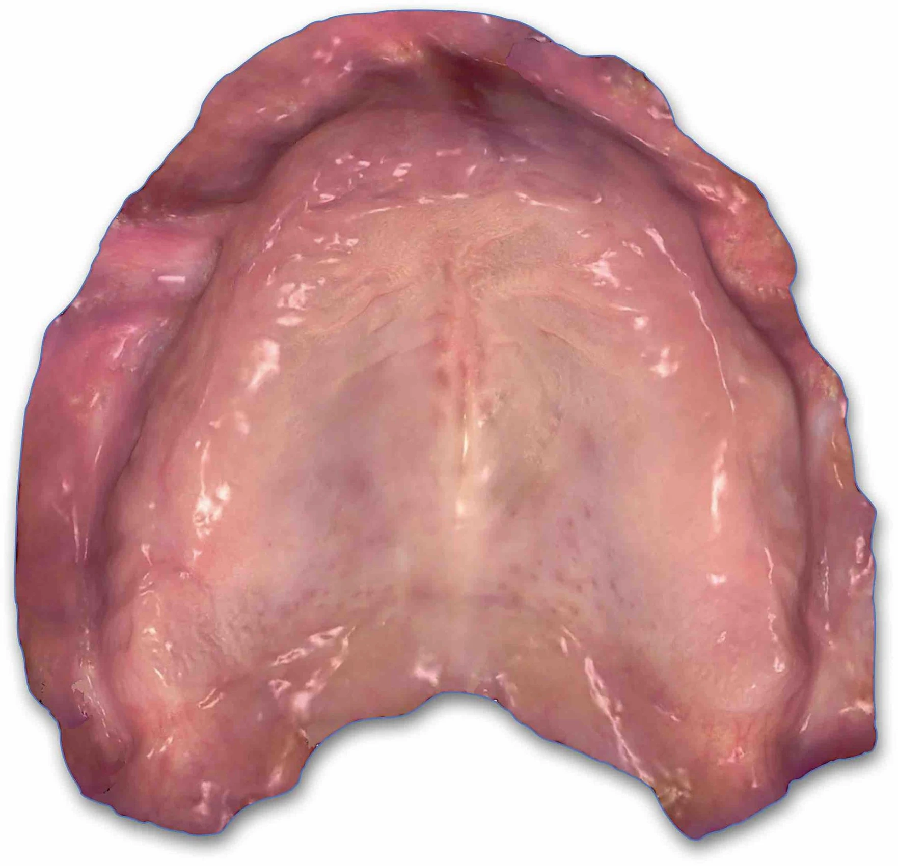 Clinical intraoral scan of the edentulous maxilla with exposure of the palate and stabilization of the vestibular tissues