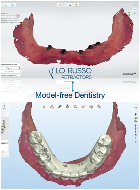 Clinical intraoral scan of an edentulous arch for the design of a digital prosthesis with accurate soft tissue and implant position acquisition