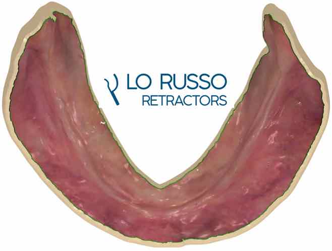 Scansione intraorale di arcate edentule con evidenza delle sfide cliniche