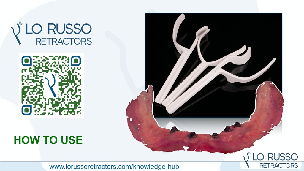 Perfect Access for Intraoral Scanning of the Edentulous Arches: A Practical Guide to Lo Russo Retractors - [C25]